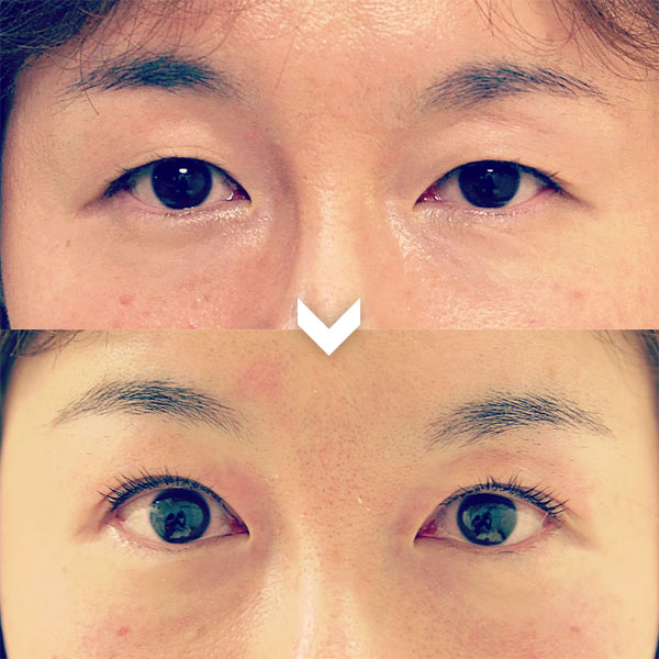 アイリッドアップパーマ®をお試しください！ | Eyelid Up Online